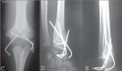 clinical presentation = "floating elbow" w/ displaced fx of both the elbow and and wrist. The most appropriate tx is prompt CRPP both the supracondylar humerus fx & distal radius fx to prevent the occurrence of compartment syndrome prompted by cas...