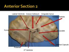 Where is the cingulate gyrus? (Coronal View)