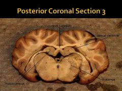 Where is the pineal body (pineal gland)? (Coronal View)