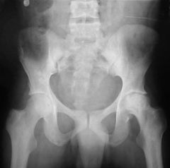 L hip osteonecrosis as a result of coagulation and vascular occlusion caused by sickle cell anemia, characterized by 2 abn hemoglobin S alleles. Under low oxygen conditions the affected blood cells become "sickle shaped" and unable to pass through...
