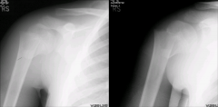 Hx: 9yo B sustains an injury to his R shoulder during a skateboarding fall. c/o pain and deformity. No deficits are present on neurovascular exam. Shoulder xrays Fig A. Which of the following is treatment? 1-Immobilization in a sling and follow-up...