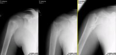 Salter-Harris II proximal humerus physeal fracture. 80% of the longitudinal growth of the humerus occurs through the proximal humerus allowing tremendous remodeling potential. The vast majority of these fractures can be treated non-operatively. A ...