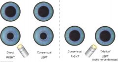 1) Light beam shines into the normal right eye; Brisk constriction of both pupils (direct response on the right and consensual response on the left)


2) Light beam swings over to the abnormal left eye; Partial dilation of both pupils occur


...