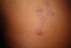 10 year old F presents after a vacation in mexico.  Parents reported spending time sitting on the beach.  MOC reports very slow expansion of the lesion.  Most likely organism? Host?