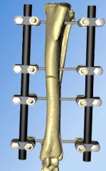 What type of fracture frame is this? What are the pros/cons?