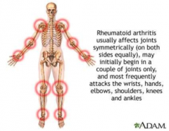 - Process IS symmetrical, however one side can be affected more than another 
- Joint deformities occur in about 33% of the people diagnosed w/ RA
- Best person is Rheumatologist, not general practitioner