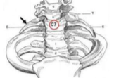 Associated with Thoracic Outlet Syndrome
Compressed neurovasculature exiting Superior Thoracic Aperture
~0.5% - 2% population have a cervical rib
Leads to confusion of vertebral levels in diagnostic images