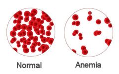 How does anemia effect viscosity and cardiac output?