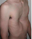 Concave depression
Congenital thoracic wall deformity: intrauterine pressure on the chest wall during development
Compression of heart and lungs