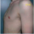 Protrusion of sternum and costal cartilages
Congenital thoracic wall deformity: connective tissue disorder
Scoliosis and congenital heart disease

