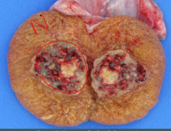 hemorrhagic and necrotic tissue- so agressive that it outgrows blood vessels and breaks them too.