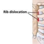RIB DISLOCATION
Displacement of sternocostal joint (costal cartilage + sternum) 

Injury to diaphragm, liver, neurovasculature