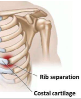 Dislocation of costochondral joint
Separated rib may be displaced superiorly and often overrides the rib above