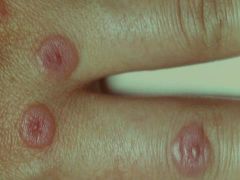 Erythema Multiforme Major (if minor- less severe usually not d/t drugs)