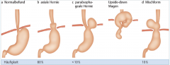 - axiale Gleithernie (80%)


- paraösophageale Hernie(<10%)


- Mischformen (10%)
