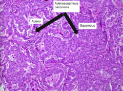 - Evidence of squamous cell carcinoma and adenocarcinoma in same neoplasm
- Peripheral tumor associated w/ scar
- Presents similarly to adenocarcinoma
- Majority of patients are smokers