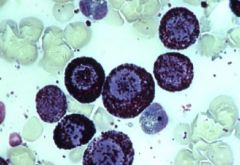 This is a common skin tumor in dogs and some cats that can be highly malignant.  These granules are dark purple and note the shape of the nucleus.  What is it?
A)  TVT
B)  Lymphosarcoma (cutaneous)
C)  Histeocytoma
D)  Mast Cell Tumor
E)  ...