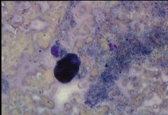 This tumor can be found in oral tissue and digits of dogs.  It is highly malignant.  It has a round to oval nuclei and brown to green-black pigment in the cytoplasm.  What is it?
A)  Mast Cell Tumor.
B)  Melanoma.
C)  TVT.
D)  Histiocytoma.
