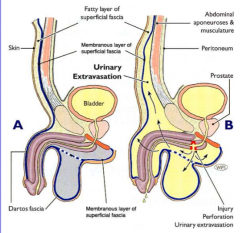 superficial fascia layer extends into penis and scrotum (Dartos fascia)
damage to the urethra can make urine/blood go into a 'pocket' surrounded by this fascia