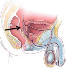 The rectovesical pouch is a potential space formed between the rectum and bladder/seminal vesicles