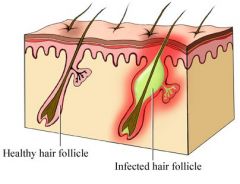 painful raised nodules that have an underlying collection of necrotic tissues/pus extends deeper than hair follicle; non toxin mediated staph skin infection