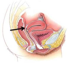 The rectouterine pouch is a potential space formed between the rectum and uterus