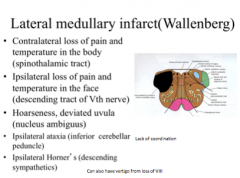 AKA Wallenberg/PICA syndrome

IX, X, X (nucleus ambiguus - hoarseness); SST, descending Vth nerve (ipsalateral pain & temp in face), Horner's (ipsa symp)