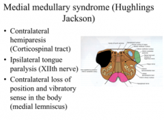 AKA Heulings Jackson (from anterior spinal artery damage)
CST, XII (contra tongue), ML