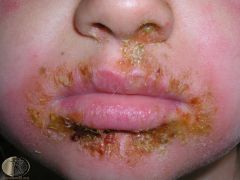 superficial infection that causes the production of pus-filled vesicle; epidermal (cutaneous); non toxin mediated staph skin infection 