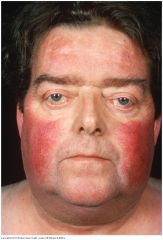 The increased adrenal cortisol production of Cushing's syndrome produces a round or "moon" face with red cheeks. Excessive hair growth may be present in the mustache and sideburn area and on the chin


 


 