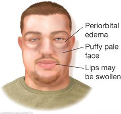 The face is edematous and often pale. Swelling usually appears first around the eyes and in the morning. The eyes may become slitlike when edema is severe


 