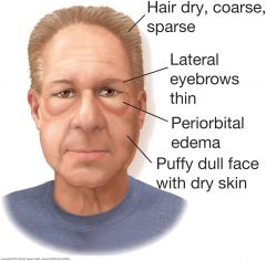 The patient with severe hypothyroidism (myxedema) has a dull, puffy facies. The edema often pronounced around the eyes, does not pit with pressure. The hair and eyebrows are dry, coarse, and thinned. The skin is dry.


 