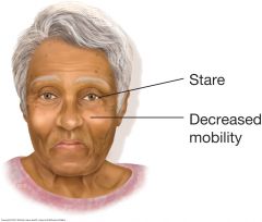 Decreased facial mobility blunts expression. A masklike face may result, with decreased blinking and a characteristic stare. Since the neck and upper trunk tend to flex forward, the patient seems to peer upward toward the observer. Facial skin bec...