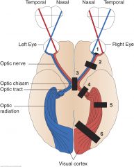 Homonymous Left Superior Quadrantic Defect (right optic radiation, partial) (5)


 