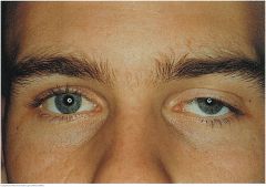 A drooping of the upper eyelid. Causes include myasthenia gravis, damage to the oculomotor nerve, and damage to the sympathetic nerve supply (Horner's syndrome). A weakened muscle, relaxed tissues, and the weight of the herniated fat may cause sen...