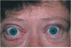 A wide-eyed stare suggests retracted eyelids. Note the rim of sclera between the upper lid and the iris. Retracted lids and "lid lag" when eyes move from up to down markedly increase the likelihood of hyperthyroidism, especially when accompanied b...