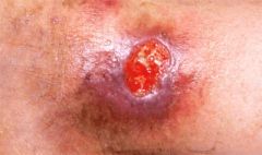A skin ulcer is a defect or loss of dermis and epidermis produced by sloughing of necrotic tissue.