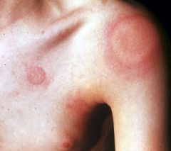 An elevated white or pink compressible, evanescent papule or plaque produced by dermal edema. A red, axon-mediated flare often surrounds it.