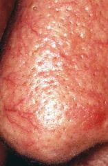 A visible vascular lesion formed by dilation of small cutaneous blood vessels.