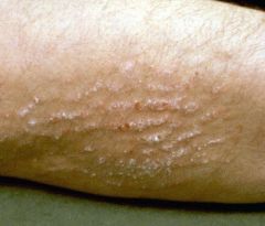 A chronic thickening of the epidermis with exaggeration of its normal markings, often as a result of (chronic) scratching or rubbing.