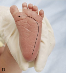Birth to 18/24 months
Stimulus: Run object from heel to base of toes
Response: Extension of the big toe and fanning of toes