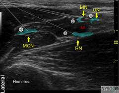 Axillary arm block U/S presented similar to this ultrasound image. Nerves marked with numbers1-4 but not otherwise identified. 



Patient having an operation of a lacerated indexfinger under regional anaesthesia. Which combination will provide ad...
