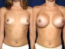 Help your body promote breasts enlargement naturally
