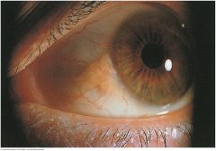 A harmless yellowish triangular nodule in the bulbar conjunctiva on either side of the iris. Appears frequently with aging, first on the nasal and then on the temporal side


 