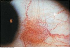 A localized ocular inflammation of the episcleral vessels. Vessels appear movable over the scleral surface. May be nodular or show only redness and dilated vessels. Seen in rheumatoid arthritis, Sjogren's syndrome, and herpes zoster


 
