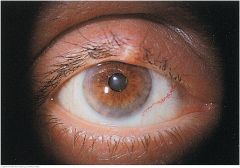 A painful, tender, red infection in a gland at the margin of the eyelid


 