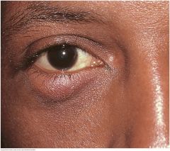 A subacute nontender, usually painless nodule involving a blocked meibomian gland. May become acutely inflamed but, unlike a sty, usually points inside the lid rather than on the lid margin


 