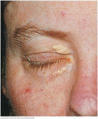 Slightly raised, yellowish, well-circumscribed plaques that appear along the nasal portions of one or both eyelids. May accompany lipid disorders.


 