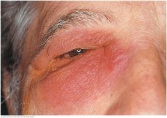A swelling between the lower eyelid and nose. An acute inflammation is painful, red and tender. Chronic inflammation is associated with obstruction of the nasolacrimal duct. Tearing is prominent, and pressure on the sac produces regurgitation of m...
