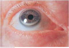 A thin grayish white arc or circle not quite at the edge of the cornea. Accompanies normal aging but also seen in younger people, especially African Americans. In young people, suggests possible hyperlipoproteinemia. usually benign


 